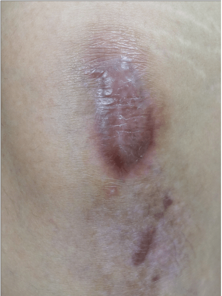 案例增生性疤痕型態