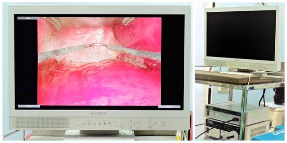 認識經內視鏡果凍矽膠隆乳