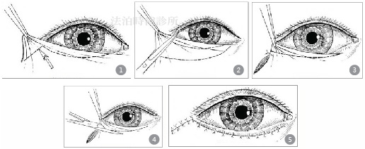 下眼瞼修皮步驟