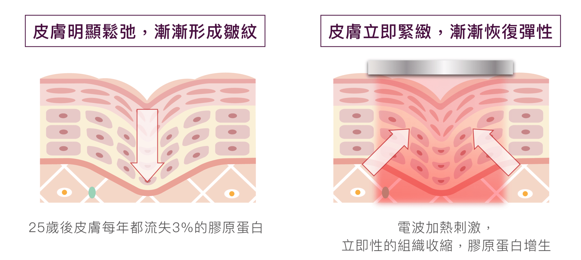 Thermage®FLX 鳳凰電波作用原理