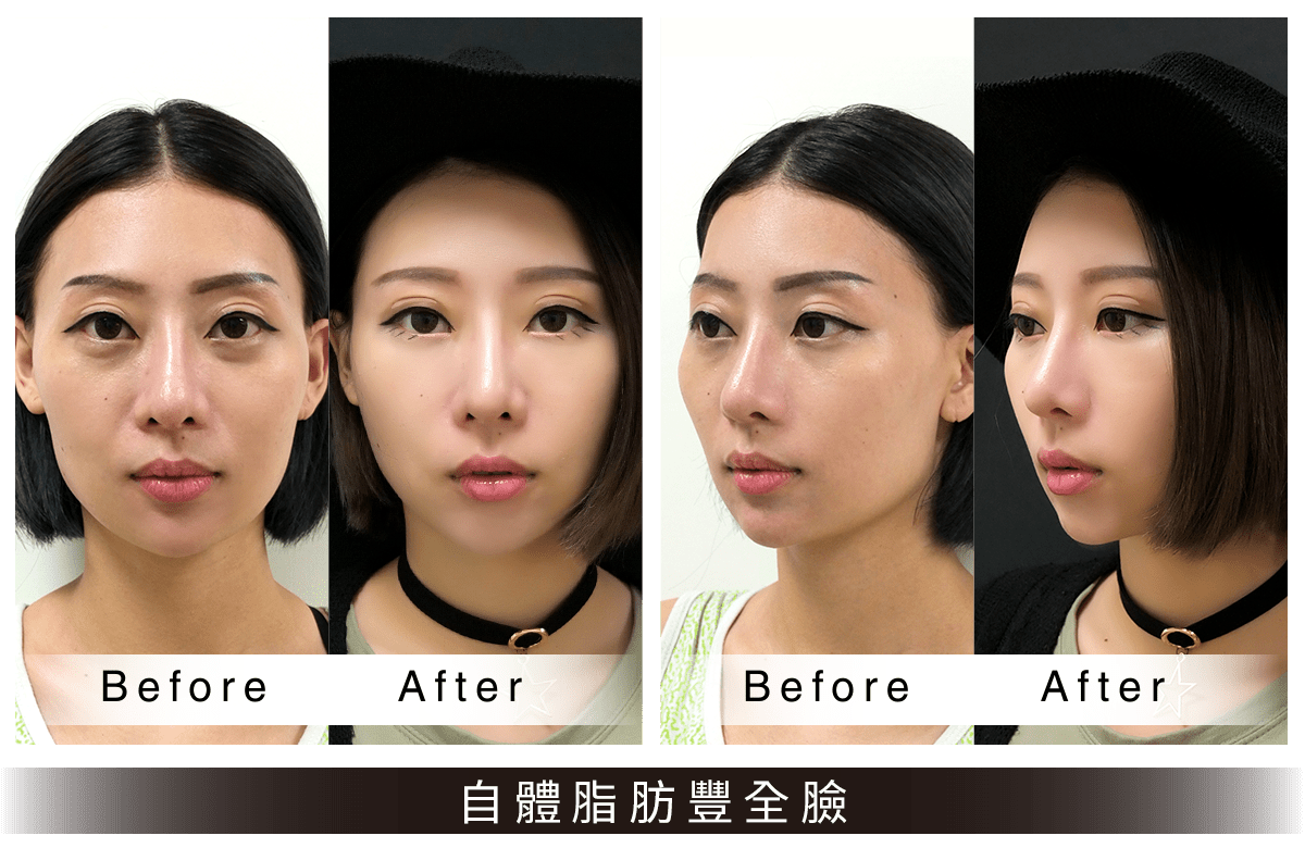 自體脂肪豐全臉案例
