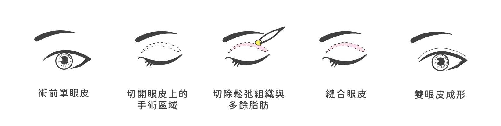 割雙眼皮手術方式