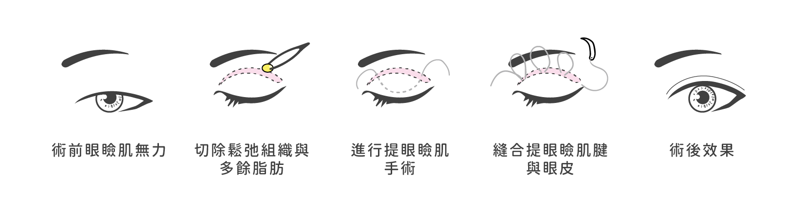 提眼瞼肌手術方式