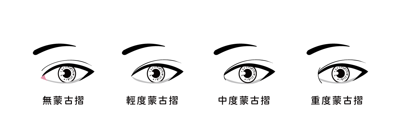 蒙古摺嚴重度分級