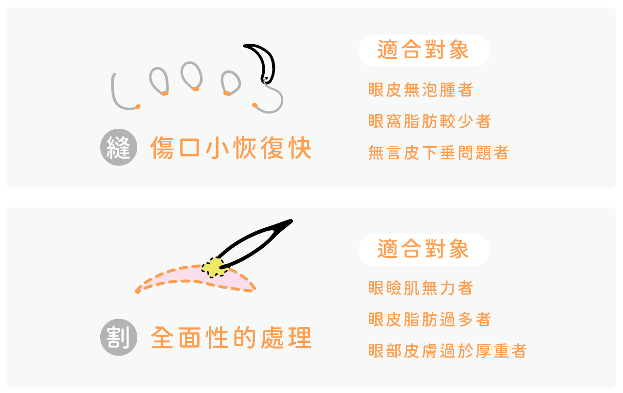 雙眼皮術式介紹