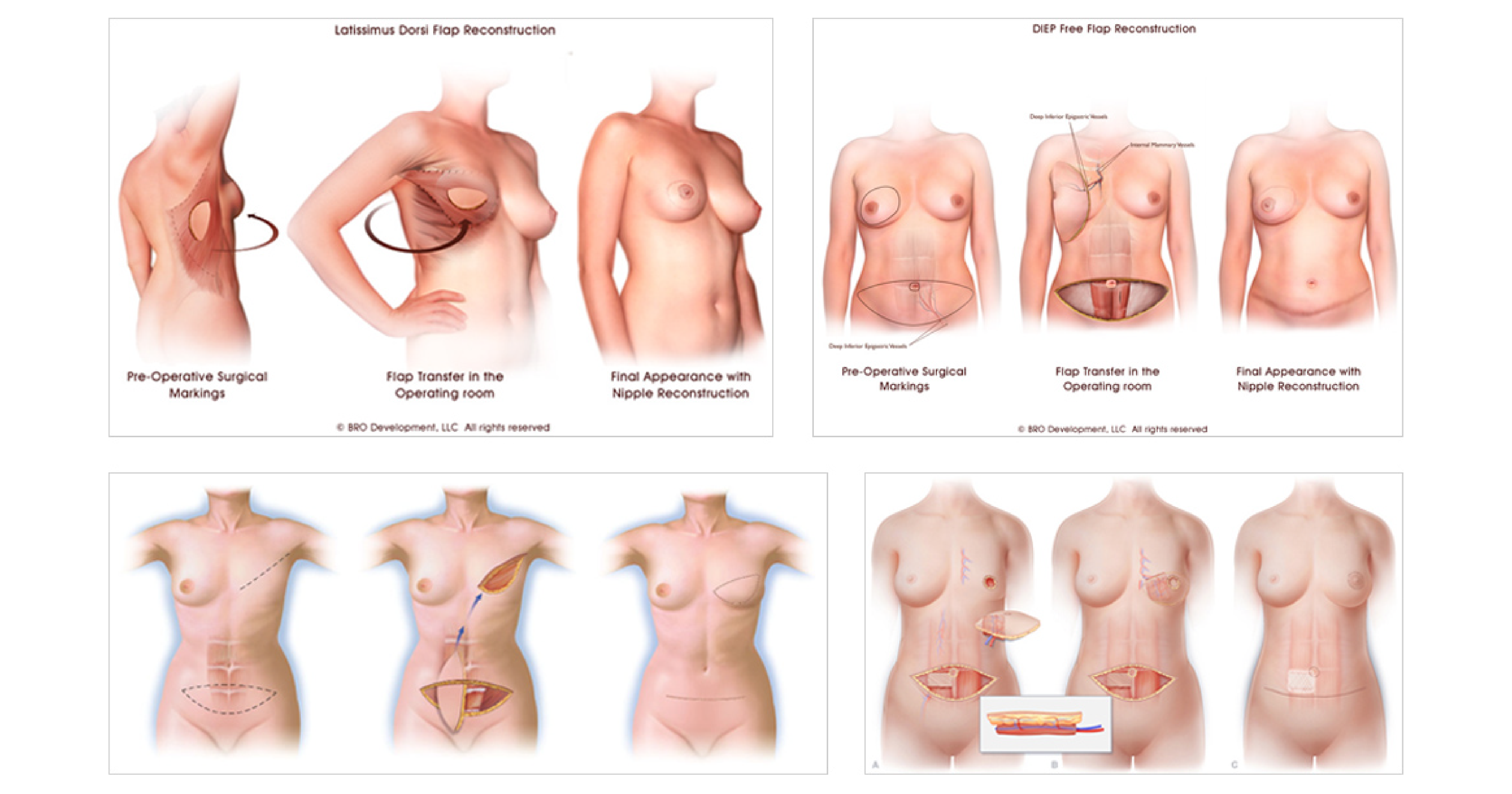自體組織重建手術
