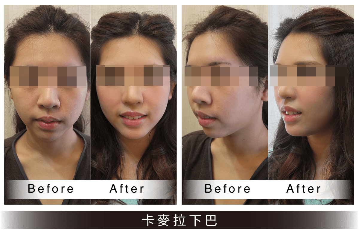 卡麥拉墊下巴案例
