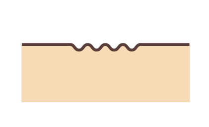 疤痕形狀凹凸不平