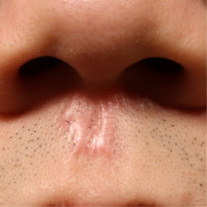 增生性疤痕案例