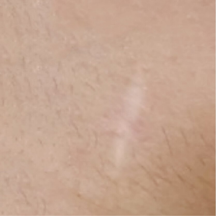 白色疤痕案例