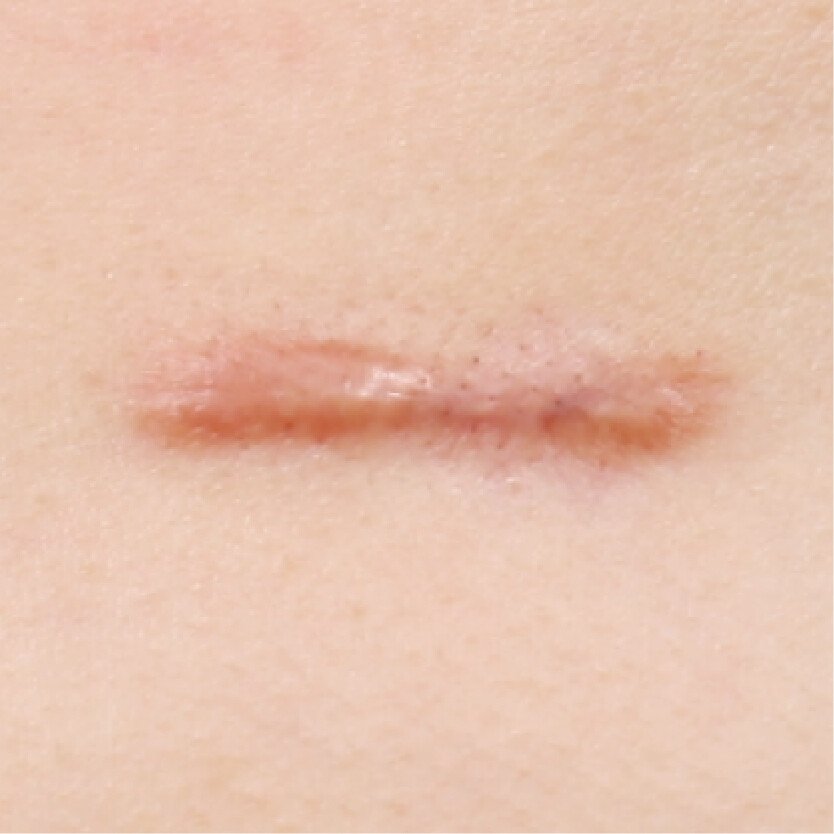 肥厚性疤痕案例