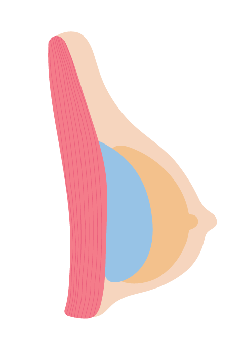 胸部植入物置於筋膜下