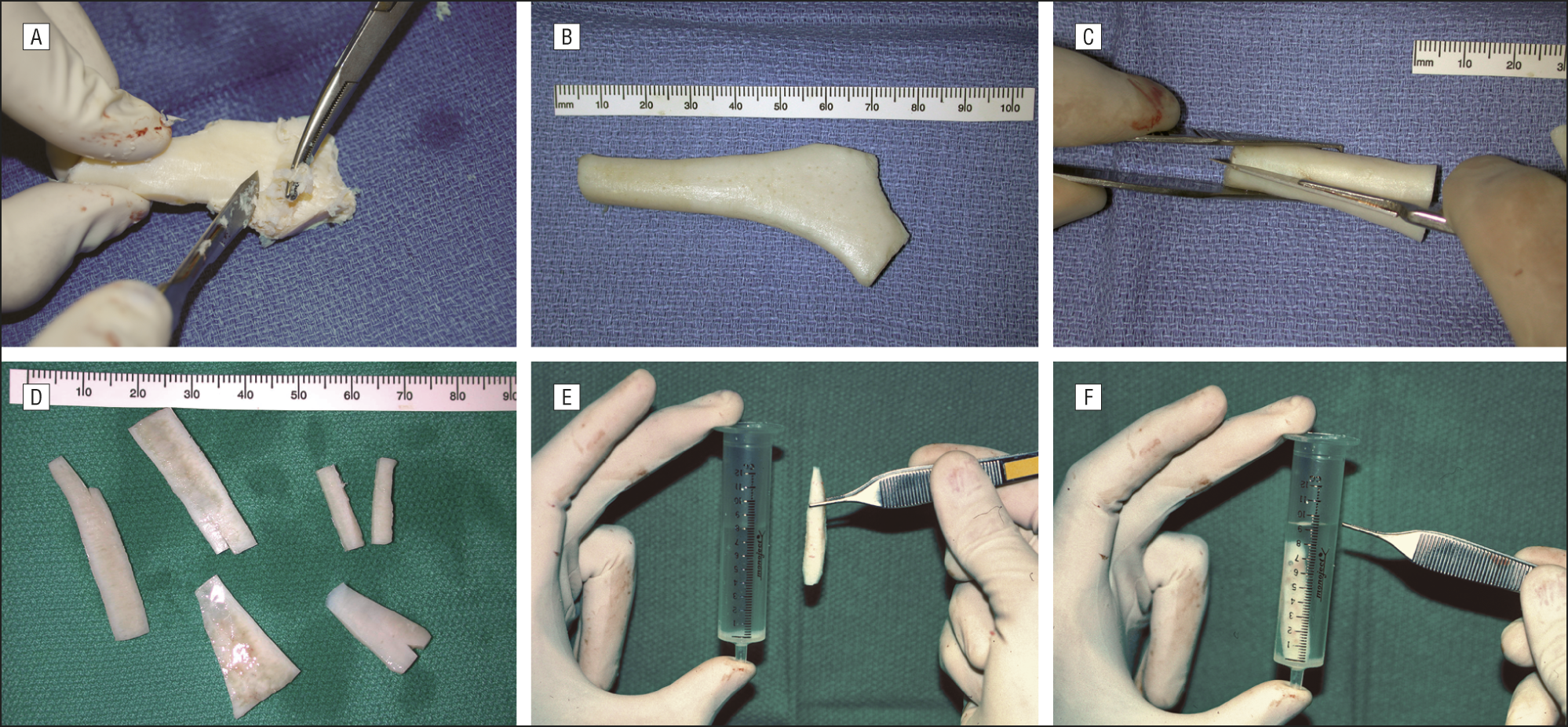 雕塑異體肋骨步驟