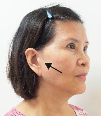 拉皮術後疤痕不明顯