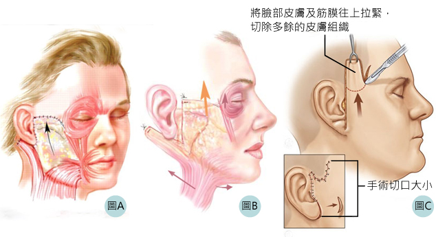中臉拉皮手術方式
