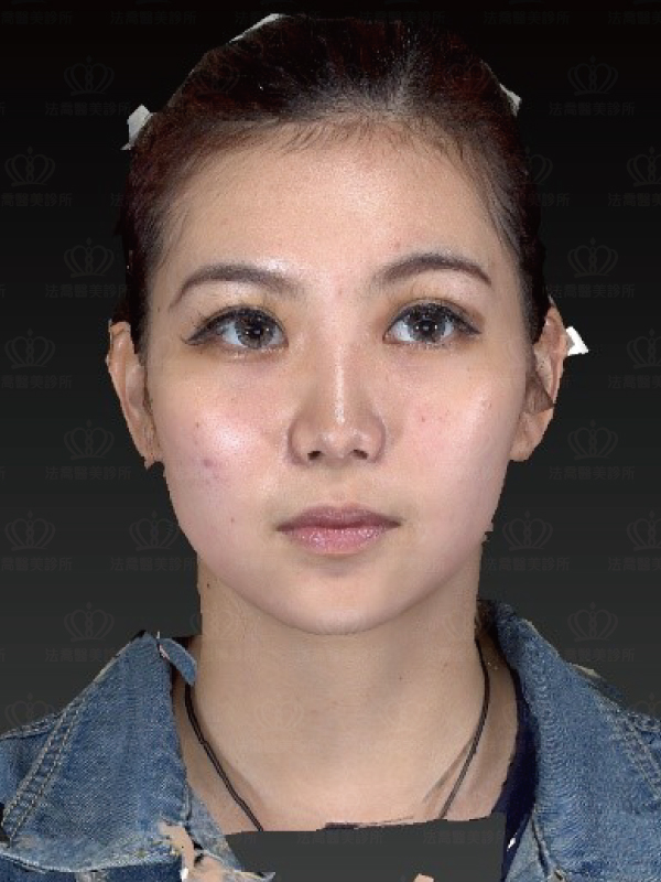 3D影像模擬自體肋骨隆鼻