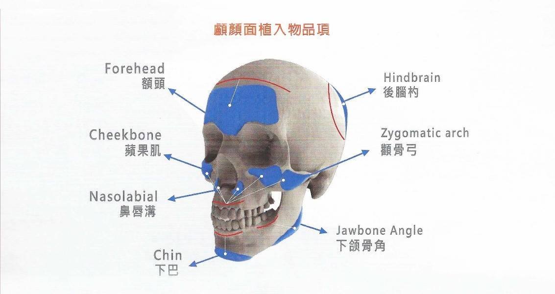 顱顏面植入物品項