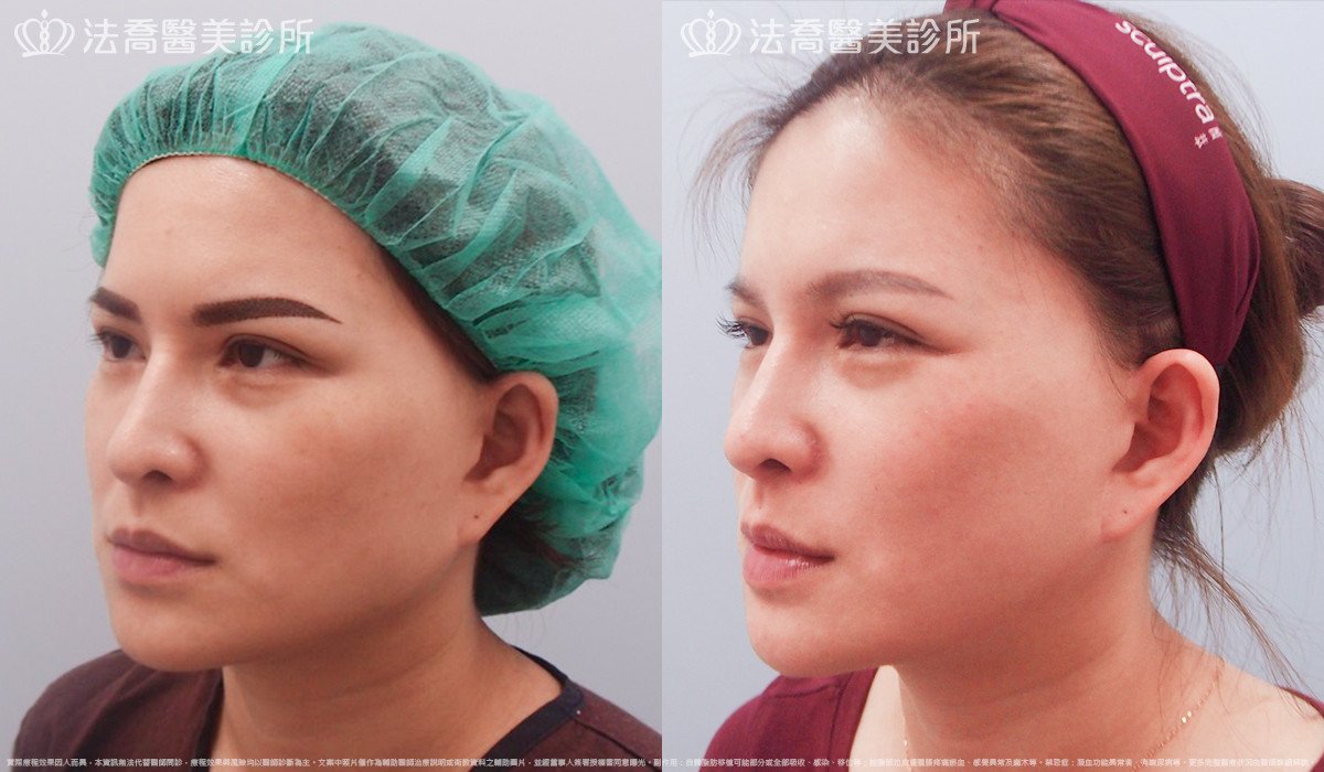 法喬醫美診所,邱浚彥,人工骨下巴