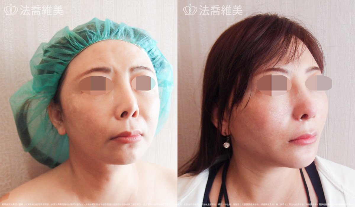 法喬醫美診所,邱浚彥,自體肋骨隆鼻