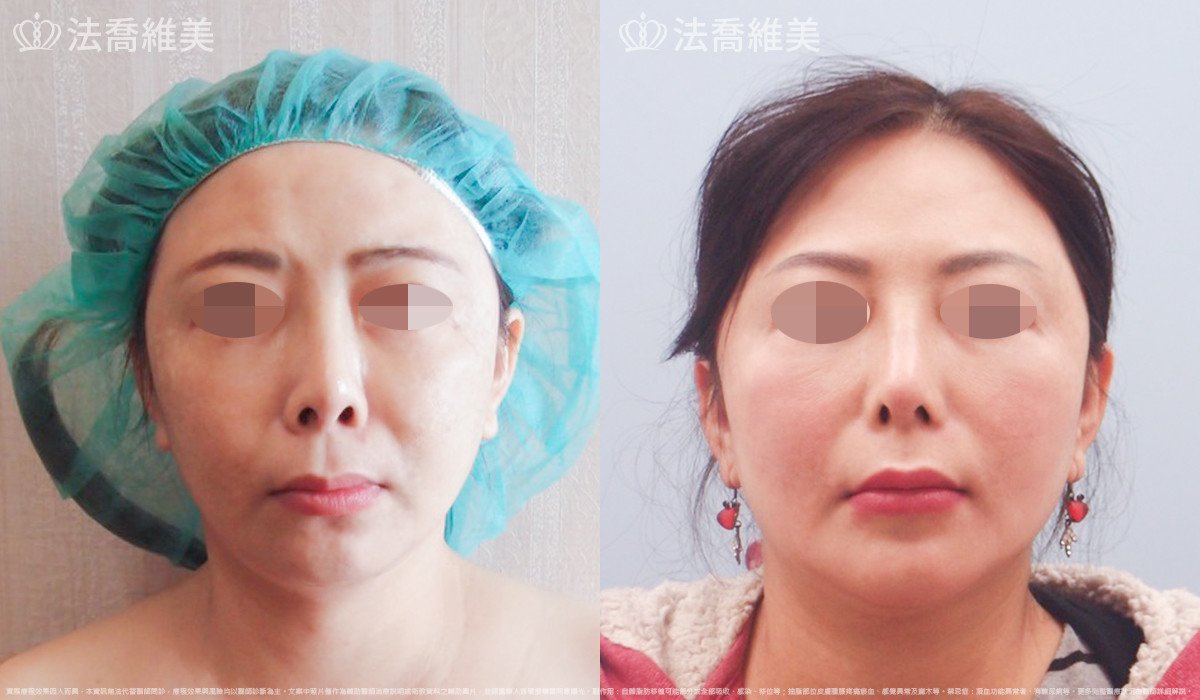 法喬醫美診所,邱浚彥,自體肋骨隆鼻