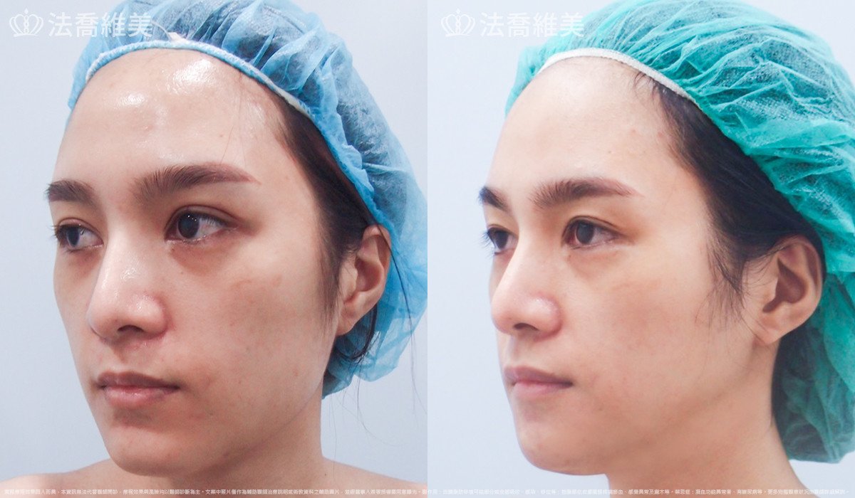 法喬醫美診所,邱浚彥,下顎角削骨