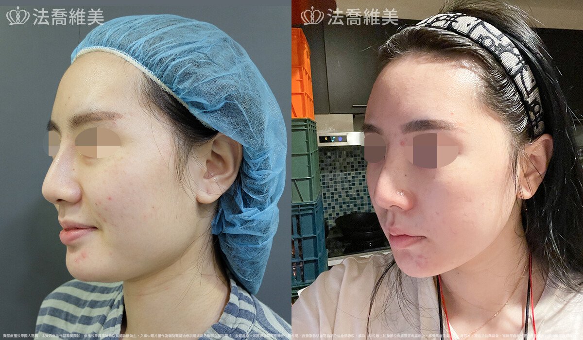 法喬醫美診所,邱浚彥,下顎角削骨