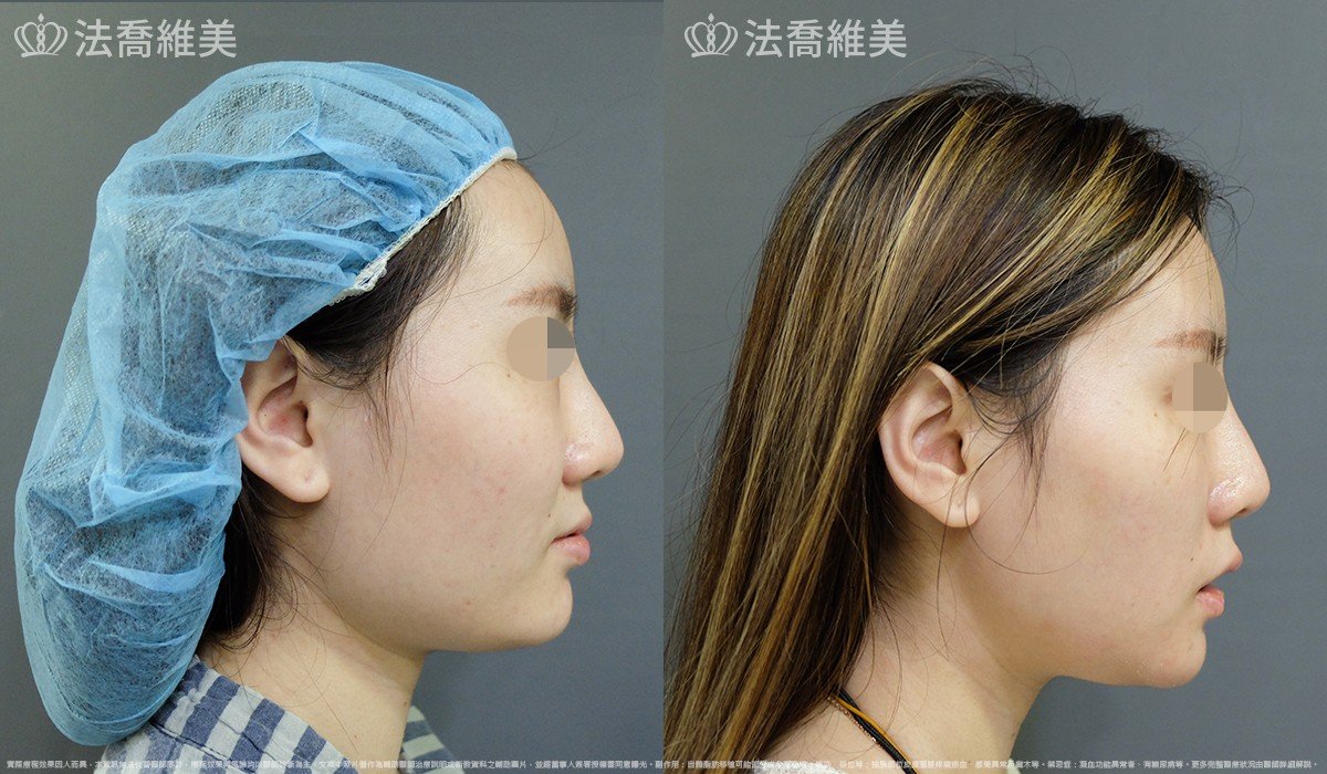 法喬醫美診所,邱浚彥,下顎角削骨