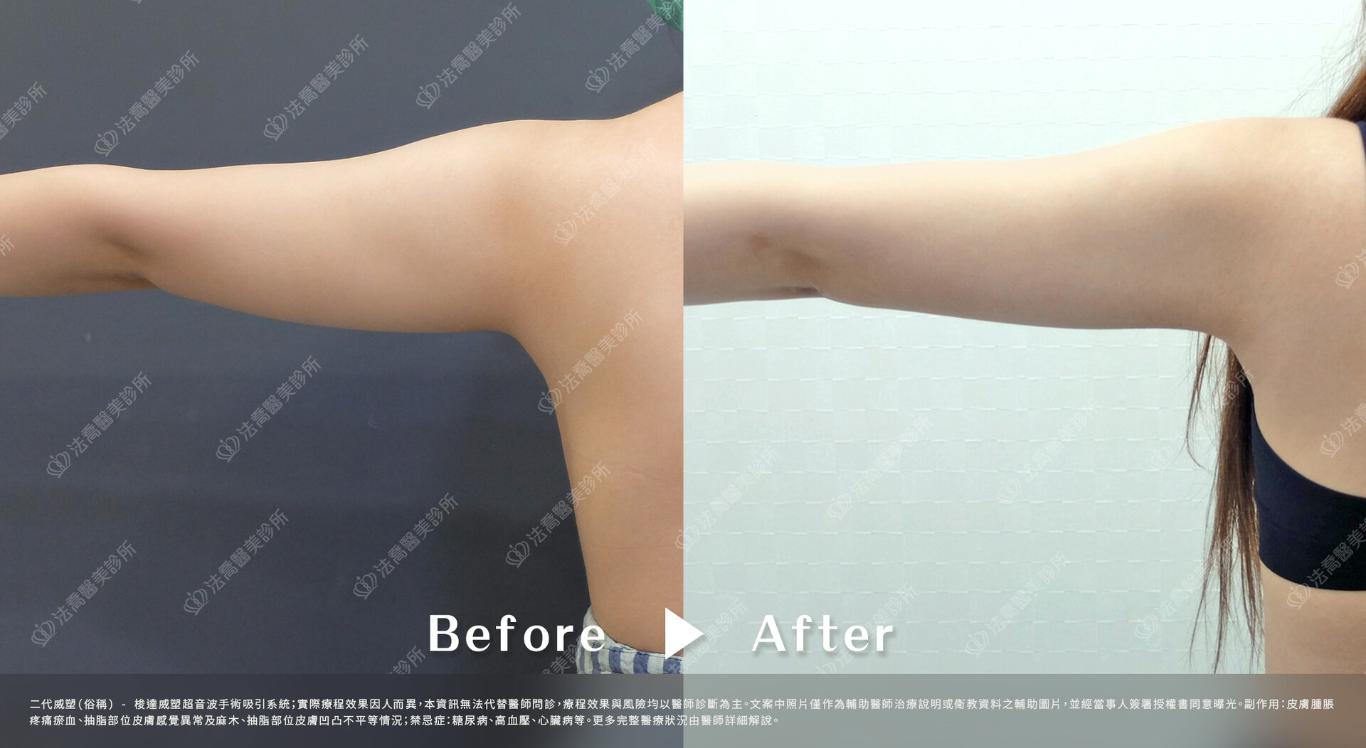 法喬醫美診所,威塑(俗稱)手臂環抽