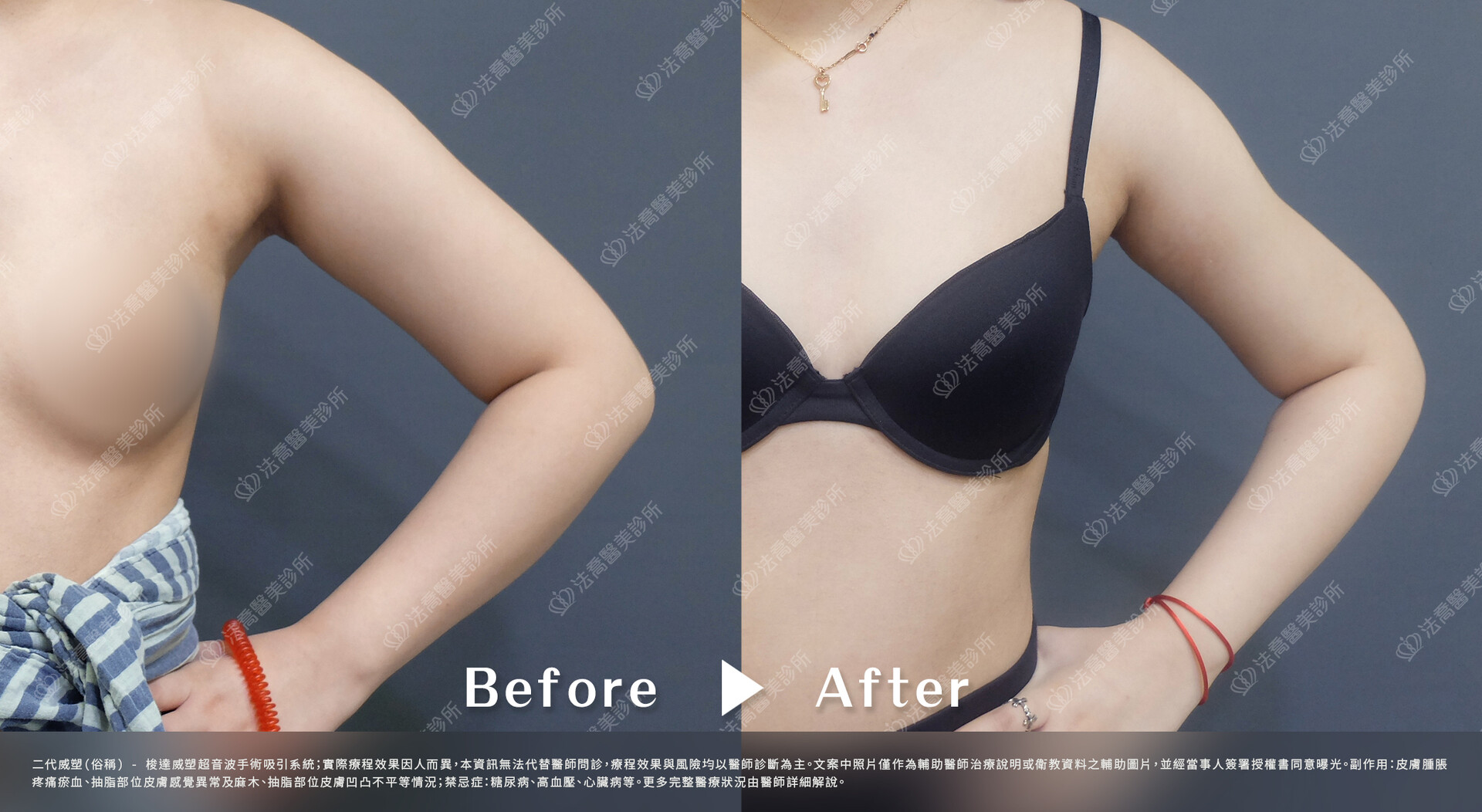 法喬醫美診所,威塑(俗稱)手臂環抽