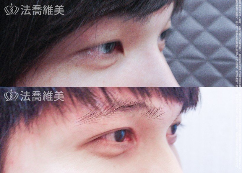 雙眼皮手術