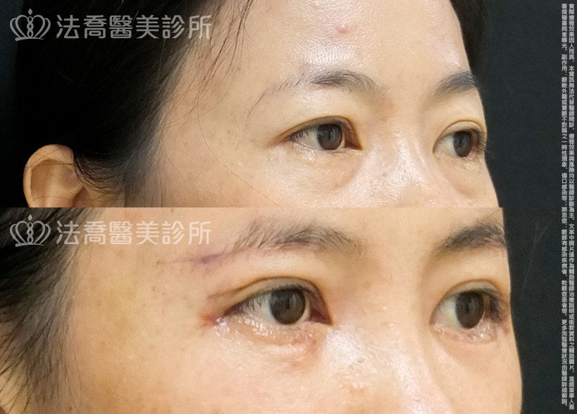 法喬醫美診所,邱浚彥,自體脂肪豐全臉,切眉,眼袋外開