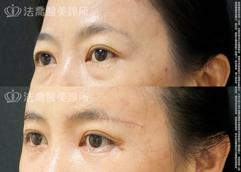 法喬醫美診所,邱浚彥,自體脂肪豐全臉,切眉,眼袋外開