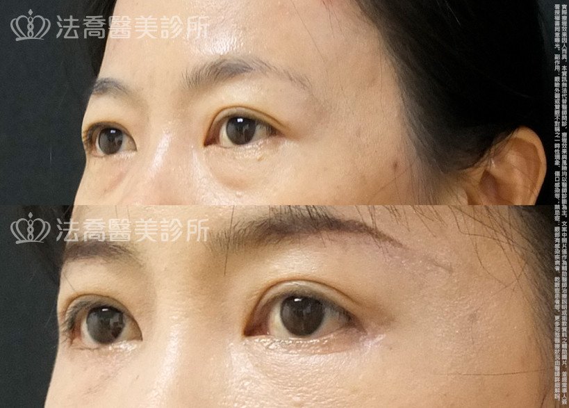 法喬醫美診所,邱浚彥,自體脂肪豐全臉,切眉,眼袋外開