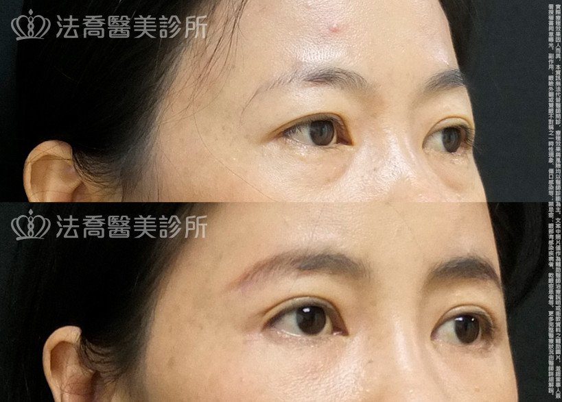 法喬醫美診所,邱浚彥,自體脂肪豐全臉,切眉,眼袋外開