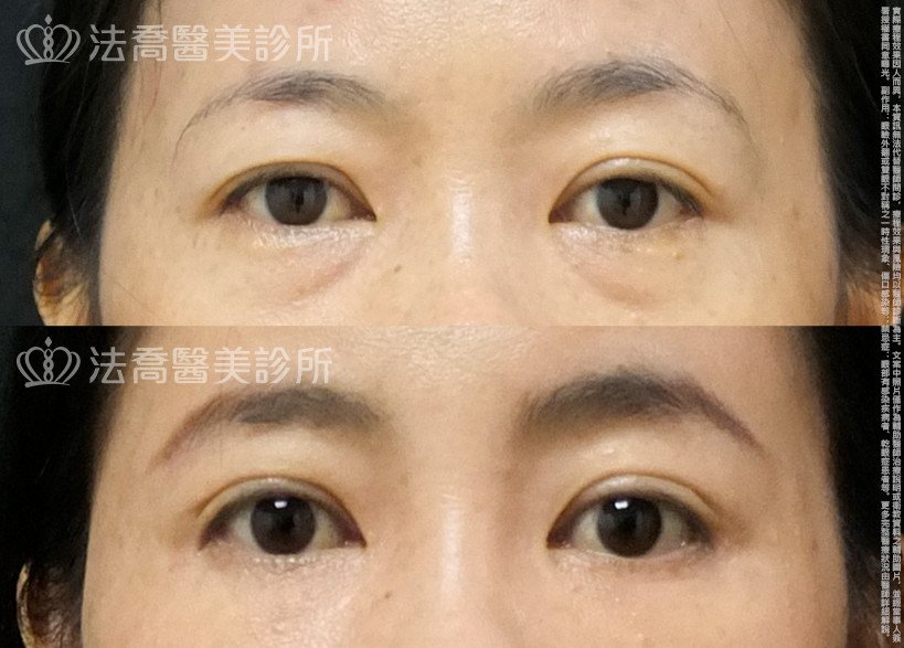 法喬醫美診所,邱浚彥,自體脂肪豐全臉,切眉,眼袋外開