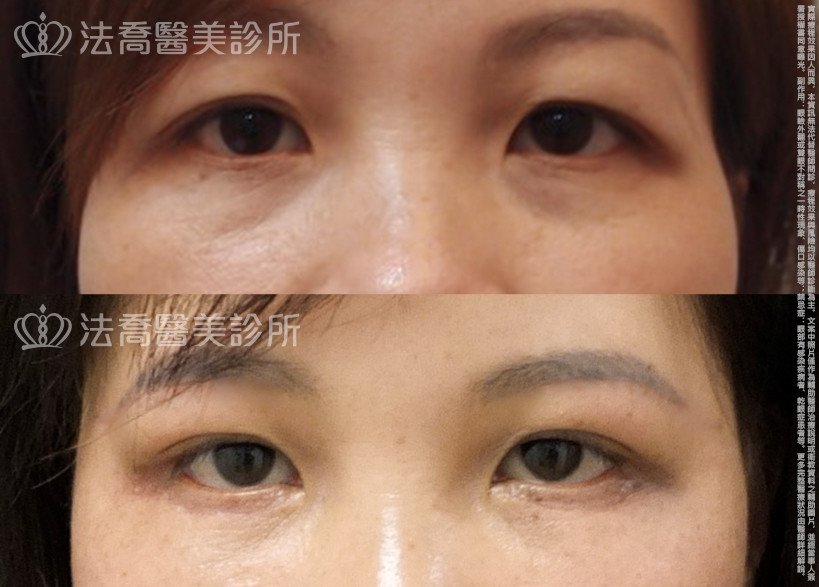 法喬醫美診所,邱浚彥,切眉