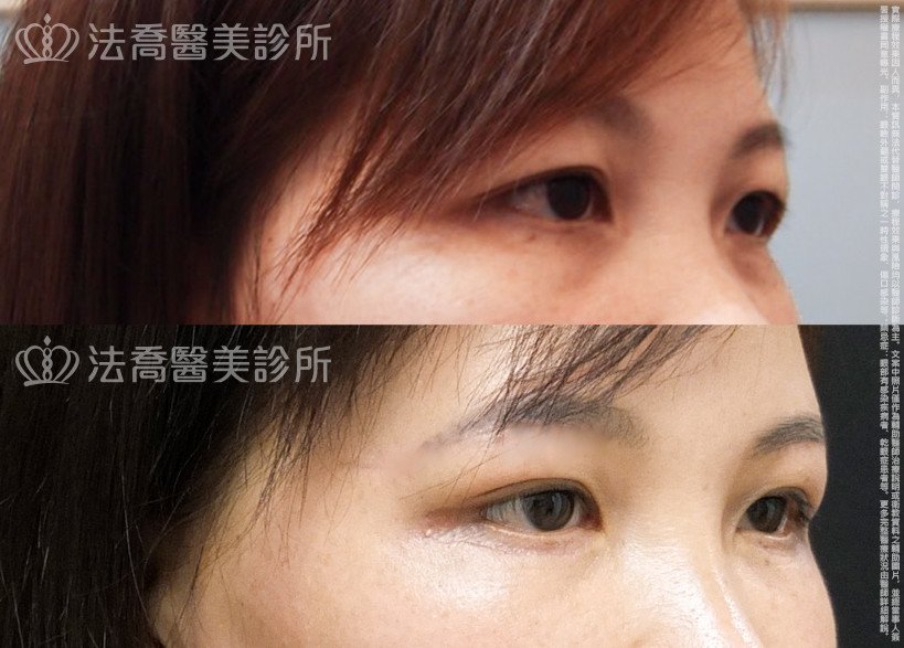 法喬醫美診所,邱浚彥,切眉