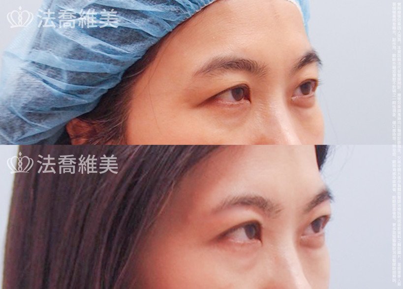 法喬醫美診所,邱浚彥,切眉