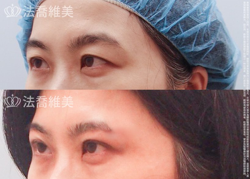 法喬醫美診所,邱浚彥,切眉