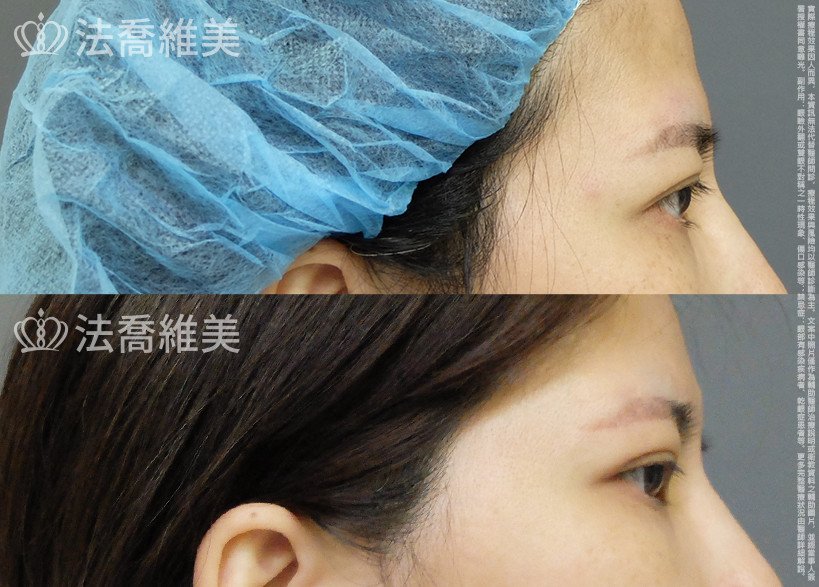 法喬醫美診所,邱浚彥,切眉