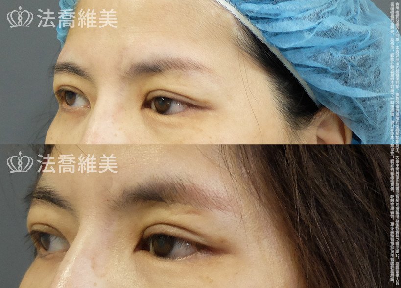 法喬醫美診所,邱浚彥,切眉