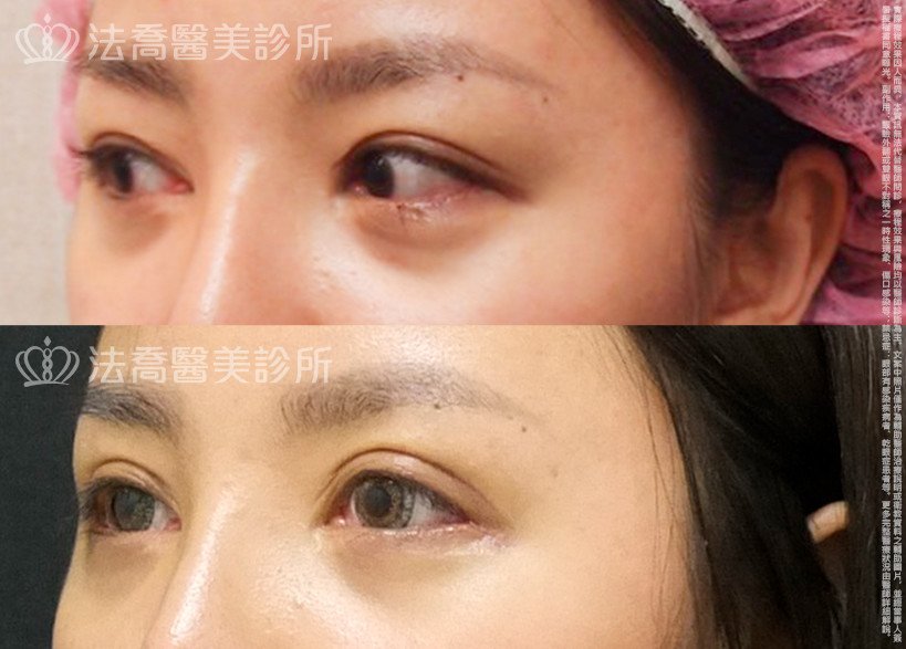 法喬醫美診所,邱浚彥,割雙眼皮,開眼頭,開眼尾
