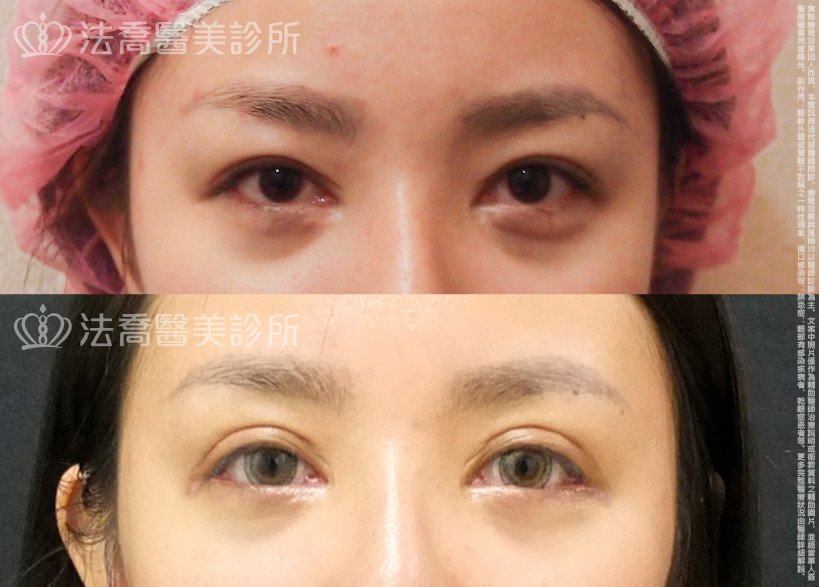 法喬醫美診所,邱浚彥,割雙眼皮,開眼頭,開眼尾