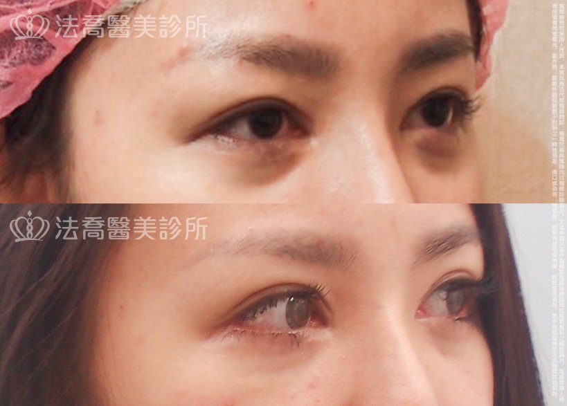 法喬醫美診所,邱浚彥,割雙眼皮,開眼頭,開眼尾