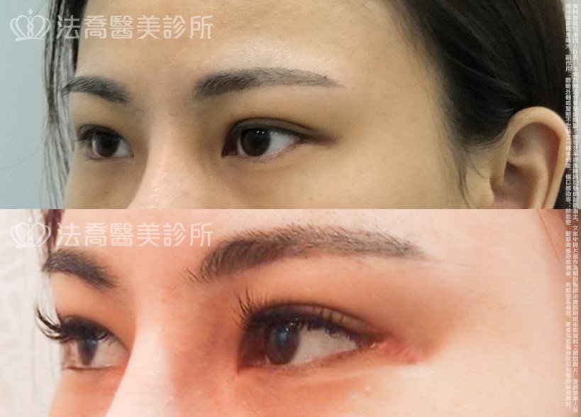 法喬醫美診所,邱浚彥,割雙眼皮,開眼頭,開眼尾