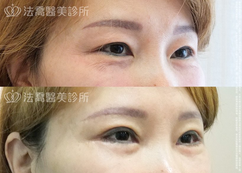 法喬醫美診所,邱浚彥,切眉