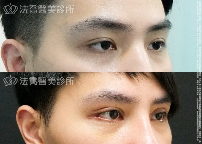 法喬醫美診所,邱浚彥,割雙眼皮,開眼頭,開眼尾