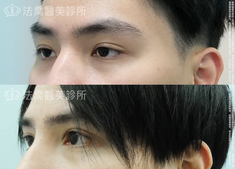 法喬醫美診所,邱浚彥,割雙眼皮,開眼頭,開眼尾