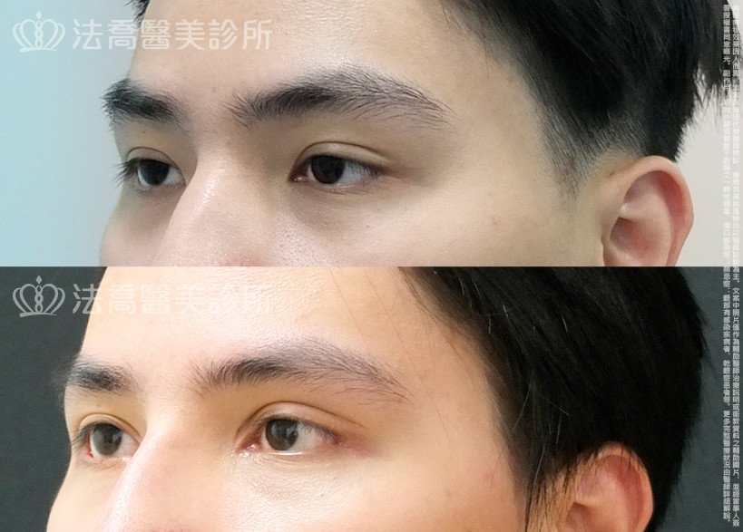 法喬醫美診所,邱浚彥,割雙眼皮,開眼頭,開眼尾