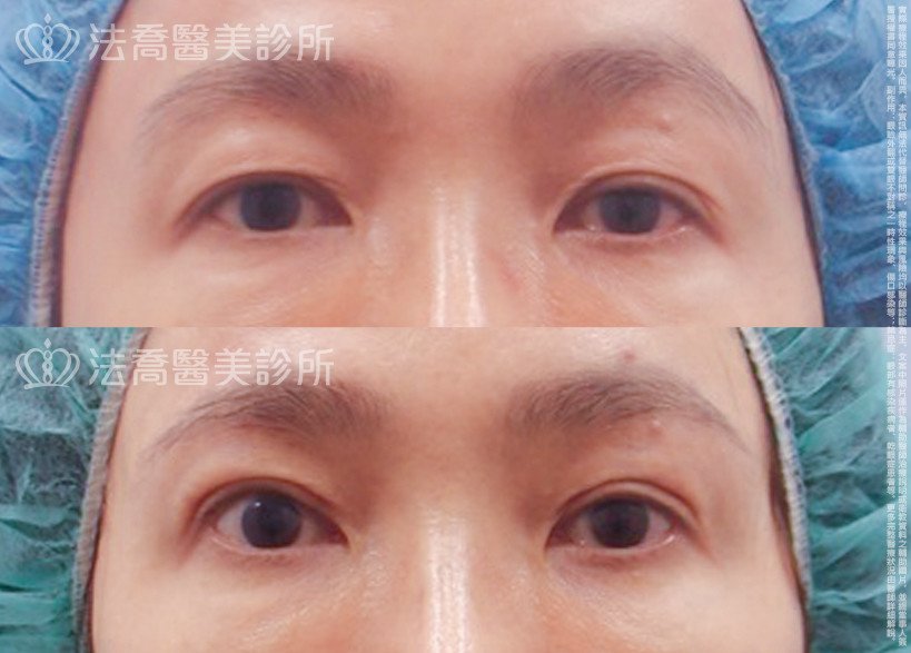 法喬醫美診所,邱浚彥,割雙眼皮,開眼頭,開眼尾